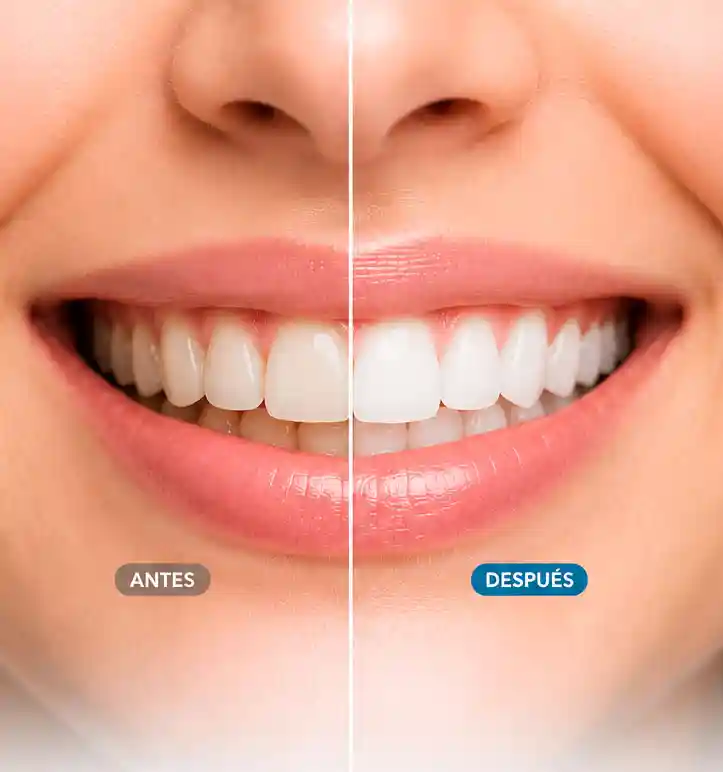 Antes y después de un blanqueamiento dental profesional en Barcelona